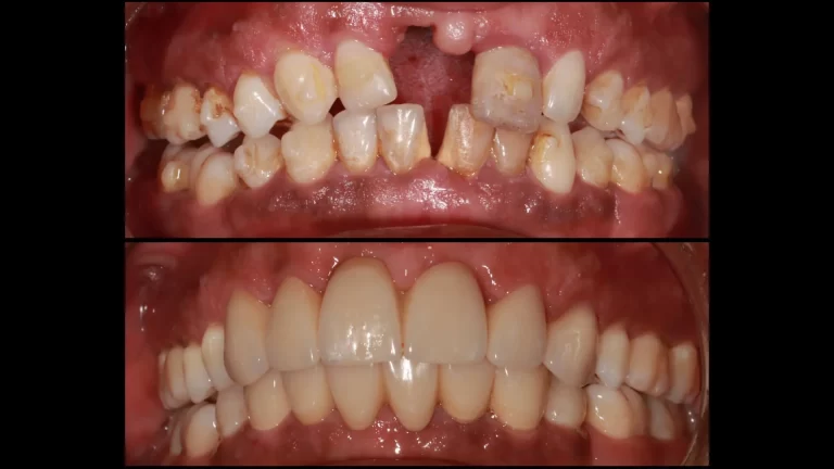 Dr Fernandes Results Chilli Media great dentist near me smaller image 768x432